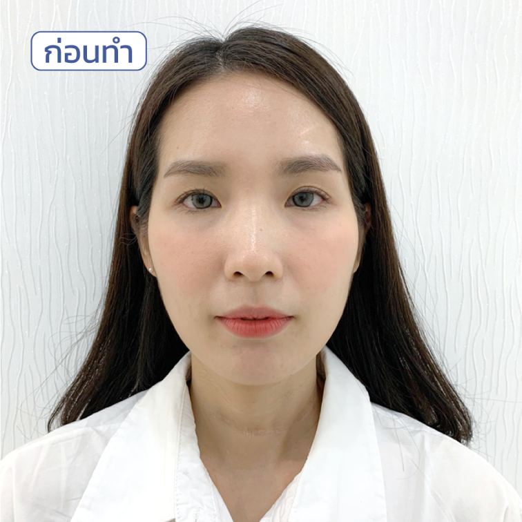 รีวิว-ฟิลเลอร์ขมับ-แก้ปัญหาขมับตอบ รีวิว-ฟิลเลอร์ขมับ-แก้ปัญหาขมับตอบ