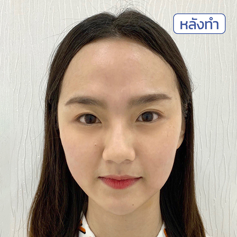 รีวิว-ฟิลเลอร์คาง รีวิว-ฟิลเลอร์คาง