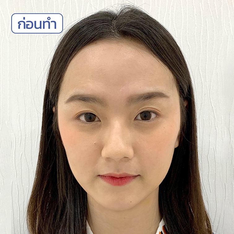 รีวิว-ฟิลเลอร์คาง รีวิว-ฟิลเลอร์คาง