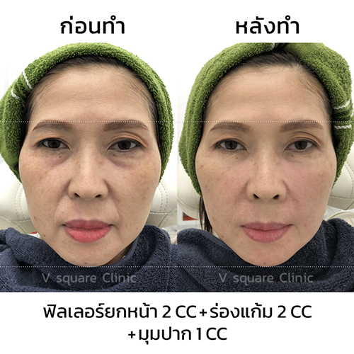 รีวิว-ฟิลเลอร์ยกหน้า