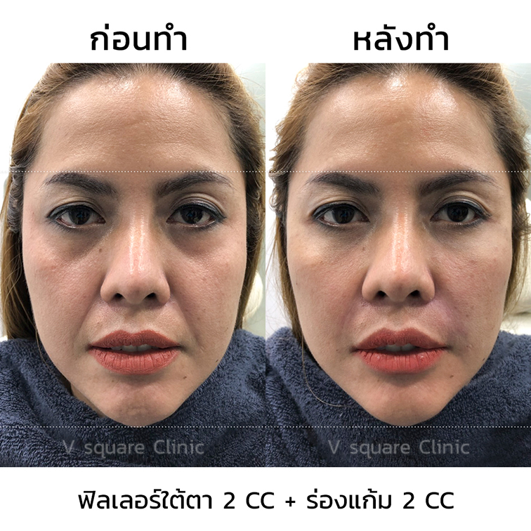 รีวิว-ฟิลเลอร์ร่องแก้ม-ใต้ตา