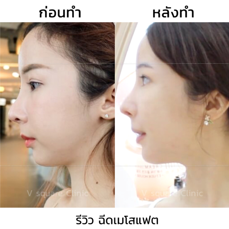 รีวิว-เมโสแฟตเหนียง