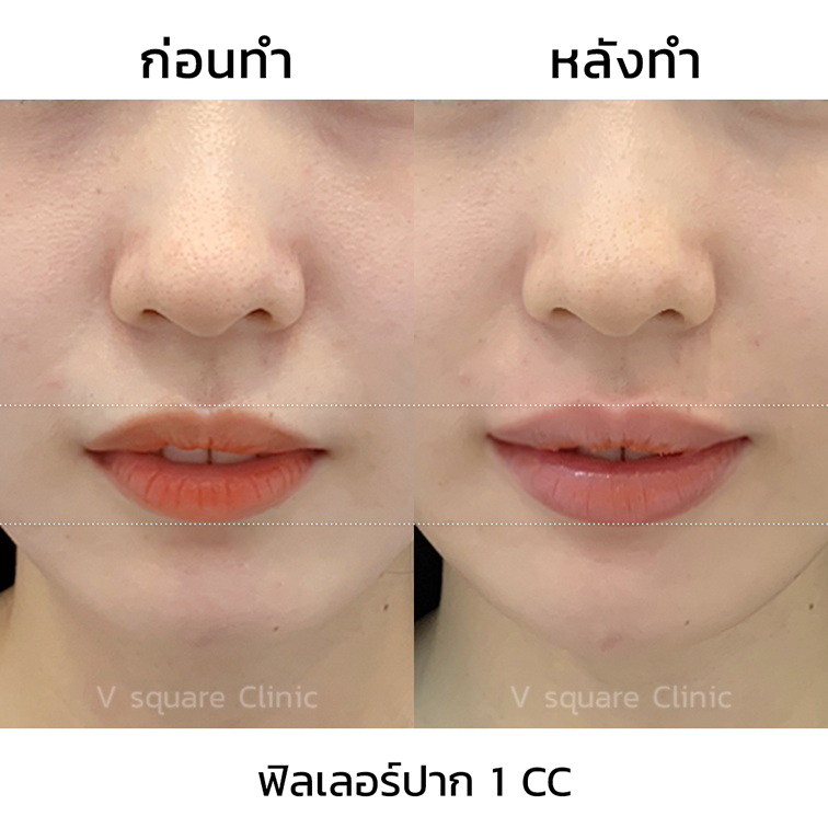 รีวิวฉีดฟิลเลอร์ปาก