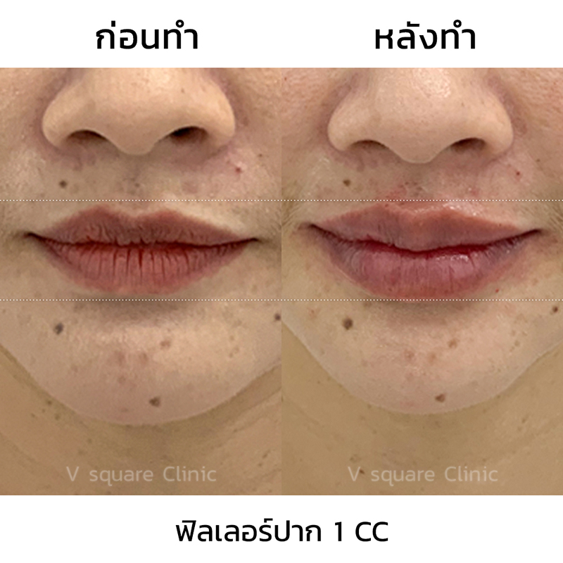 รีวิวฉีดฟิลเลอร์ปากแก้มุมปากตก. 1 CC