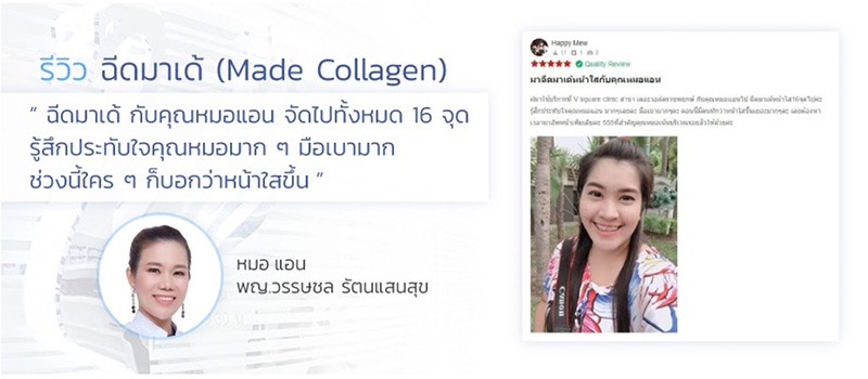 รีวิวฉีดเมโส3