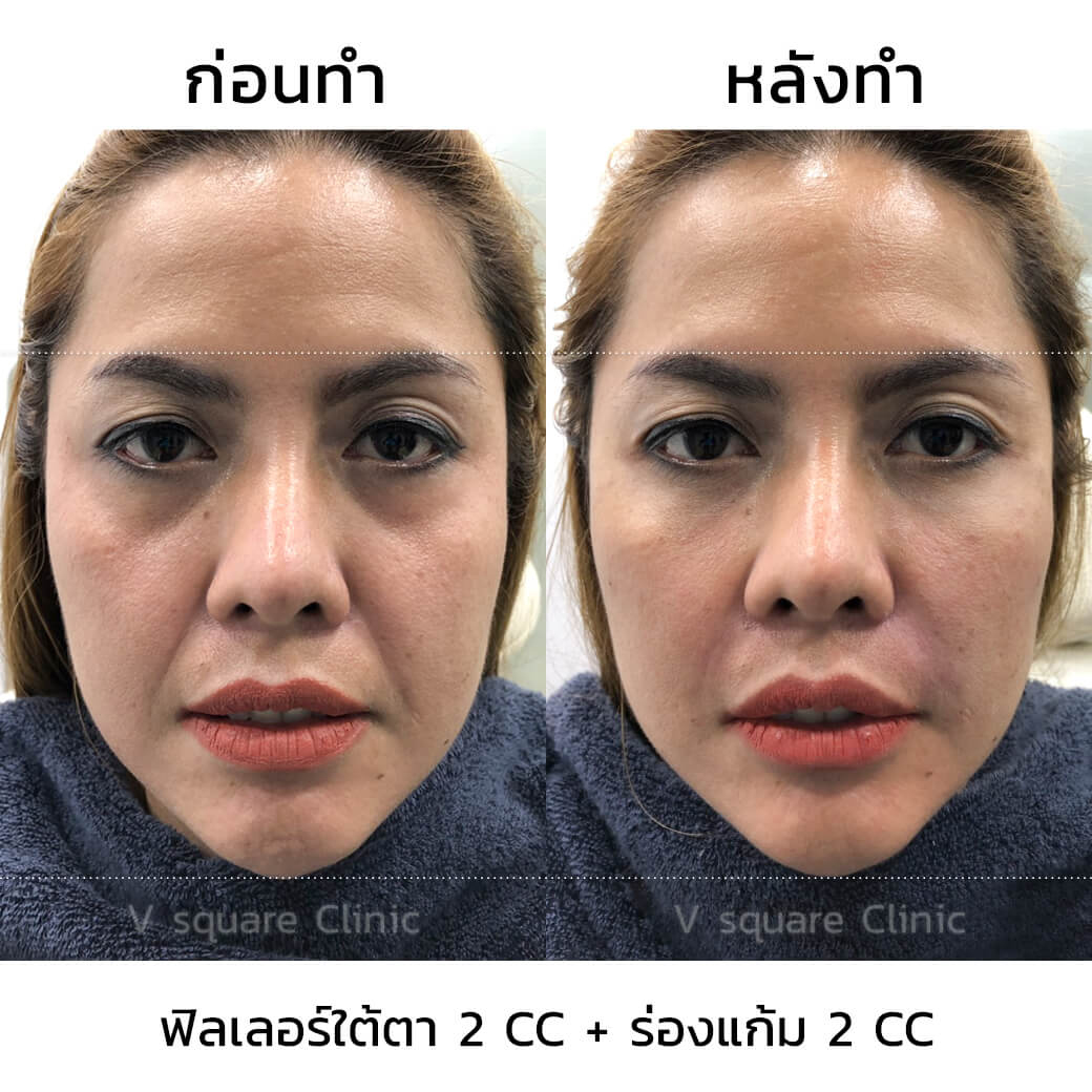 รีวิวปรับโหงวเฮ้งตา-ร่องใต้ตา1