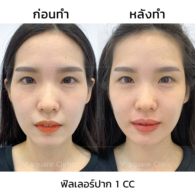 รีวิวปากกระจับ-Juvederm-Volift-ก่อนทำ-หลังทำ