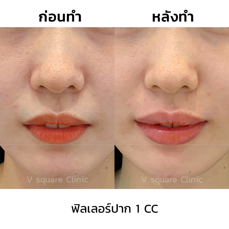 รีวิวปากกระจับ-Juvederm-Volift-ปากอวบอิ่ม