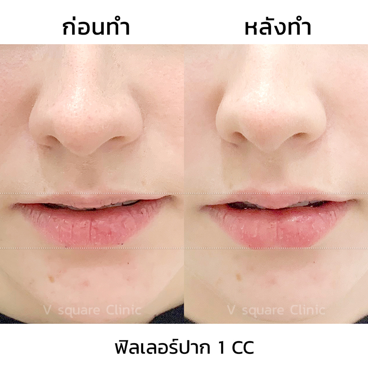 รีวิวปากกระจับ-Juvederm-volift