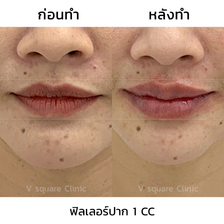 รีวิวปากกระจับ-Restylane-Refyne-1-cc