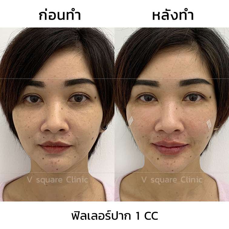 รีวิวปากกระจับ-Restylane-Refyne