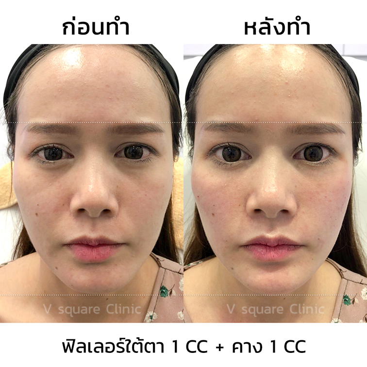 รีวิวฟิลเลอร์คาง