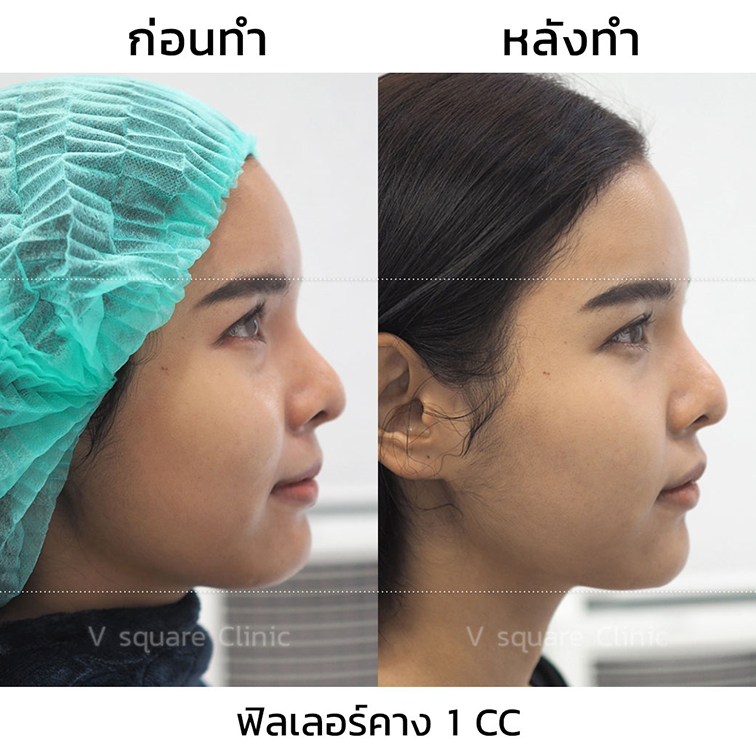 รีวิวฟิลเลอร์คาง