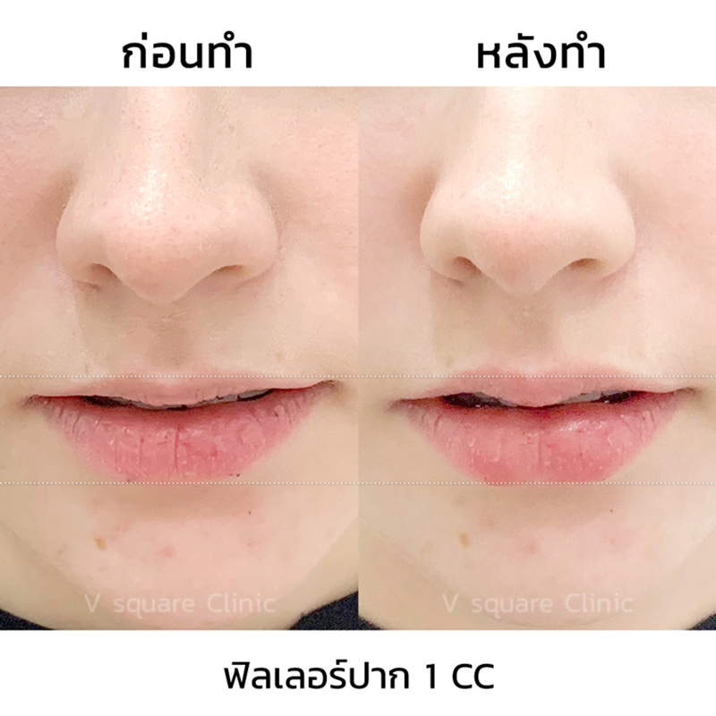 รีวิวฟิลเลอร์ปาก-1-cc ใต้ตา-2-cc