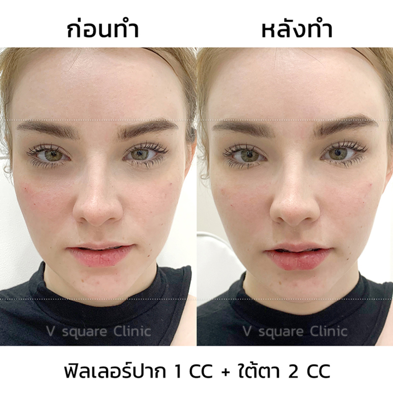 รีวิวฟิลเลอร์ปาก-1-cc ใต้ตา-2-cc