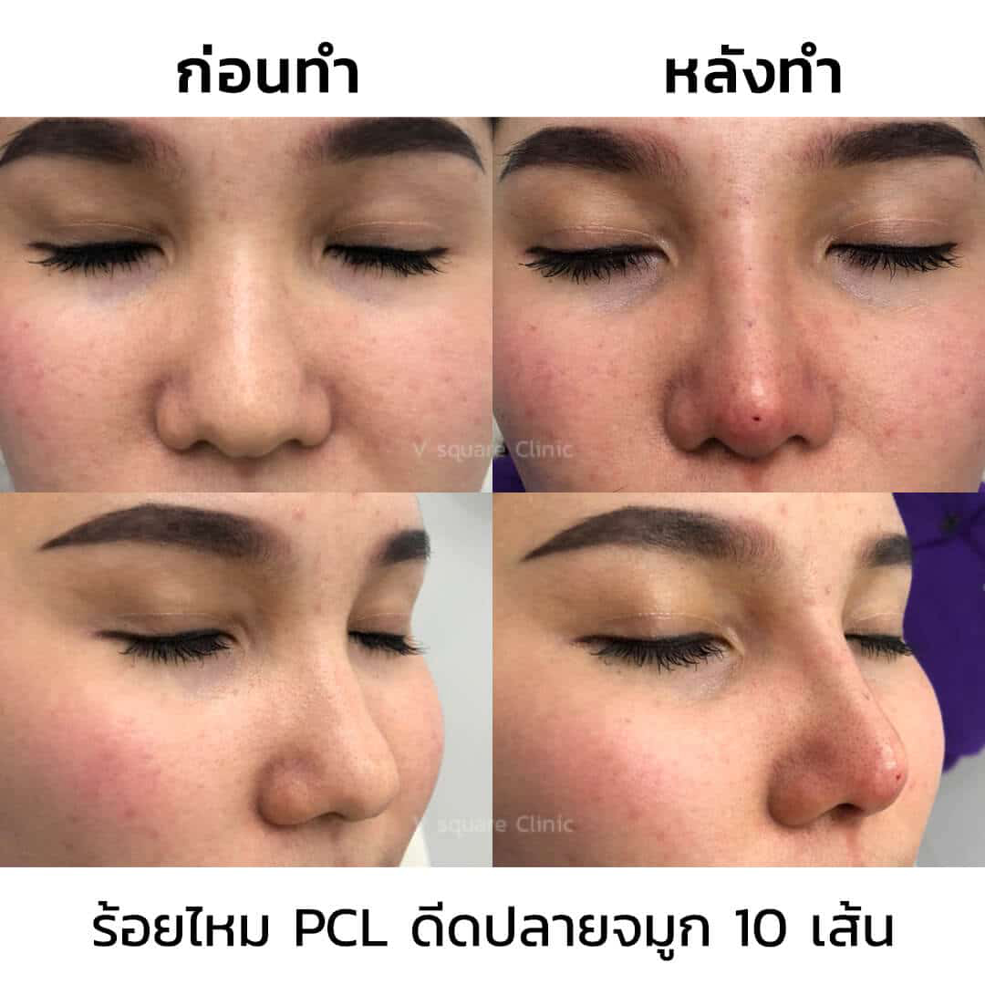 รีวิวร้อยไหมจมูกปรับโหงวเฮ้งทรงจมูกให้โด่ง