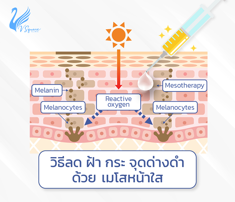 วิธีรักษาฝ้า