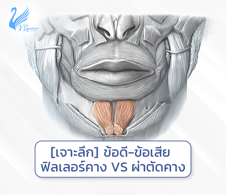 เจาะลึกข้อดีข้อเสียฟิลเลอร์คางVSผ่าตัดคาง