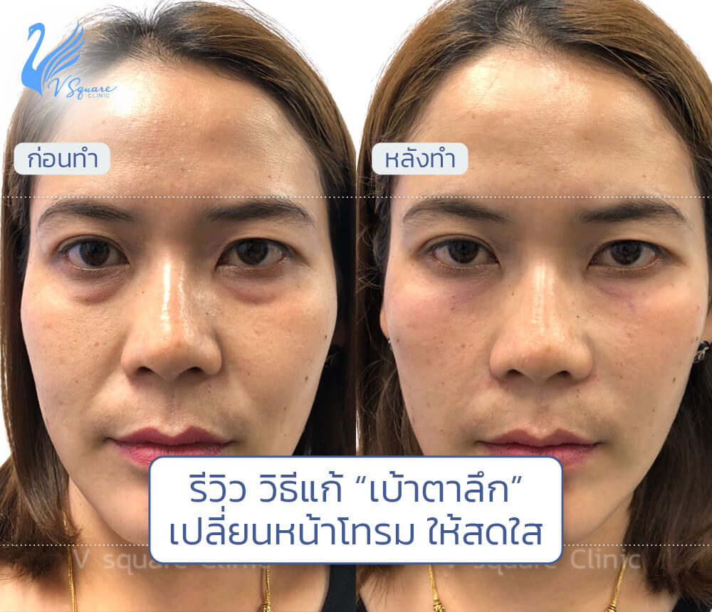 1รีวิว วิธีแก้-“เบ้าตาลึก”เปลี่ยนหน้าโทรมให้สดใส_1000x860