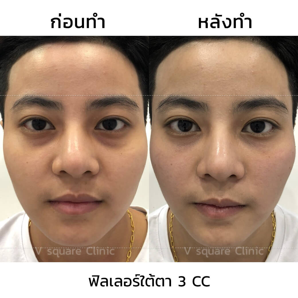 รีวิวฉีดฟิลเลอร์ใต้ตา เบ้าตาลึก