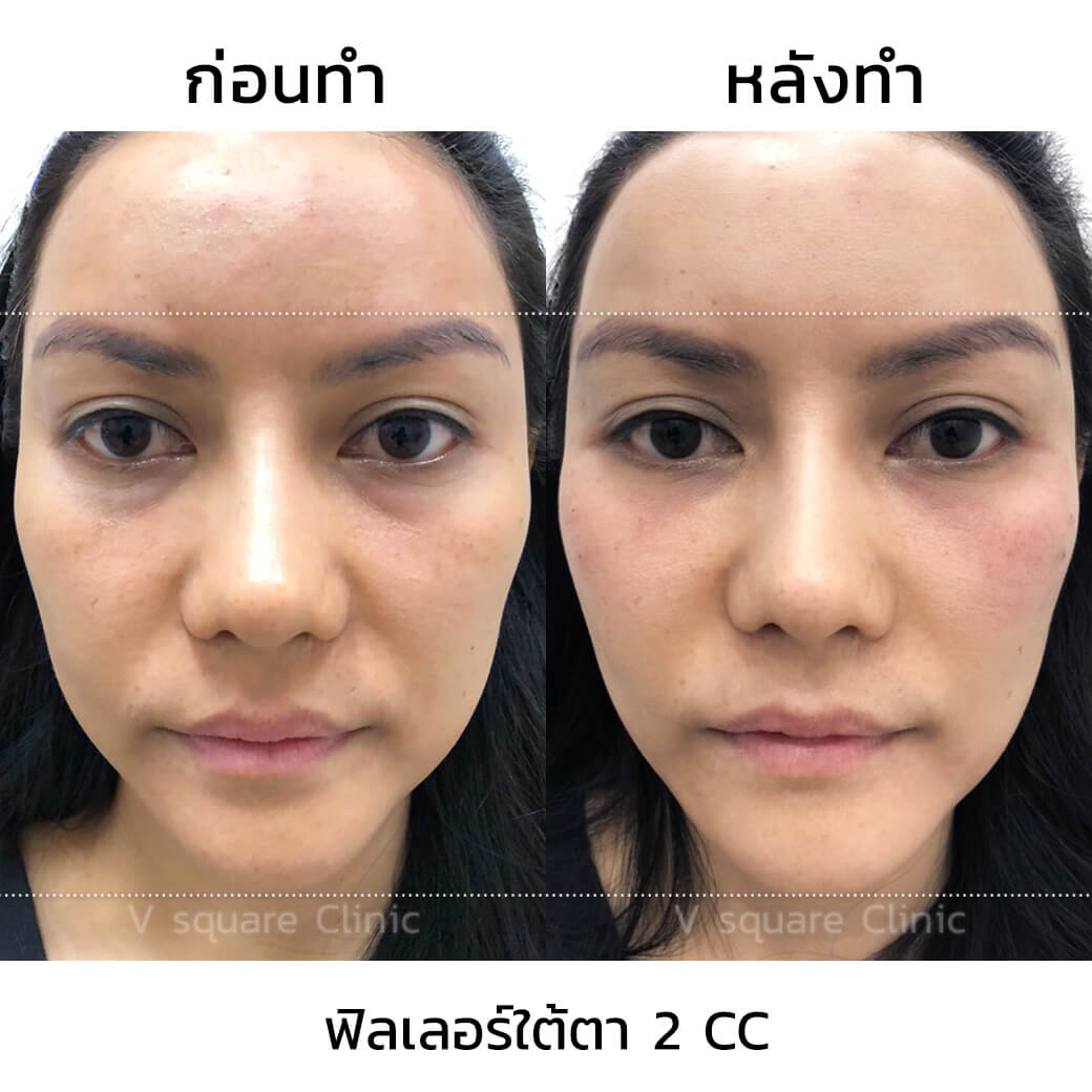 รีวิวฉีดฟิลเลอร์ใต้ตา