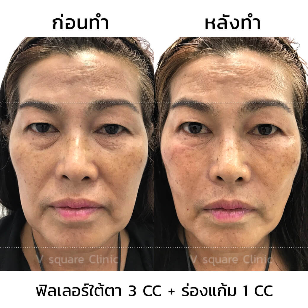 รีวิวฉีดฟิลเลอร์ใต้ตาและร่องแก้ม