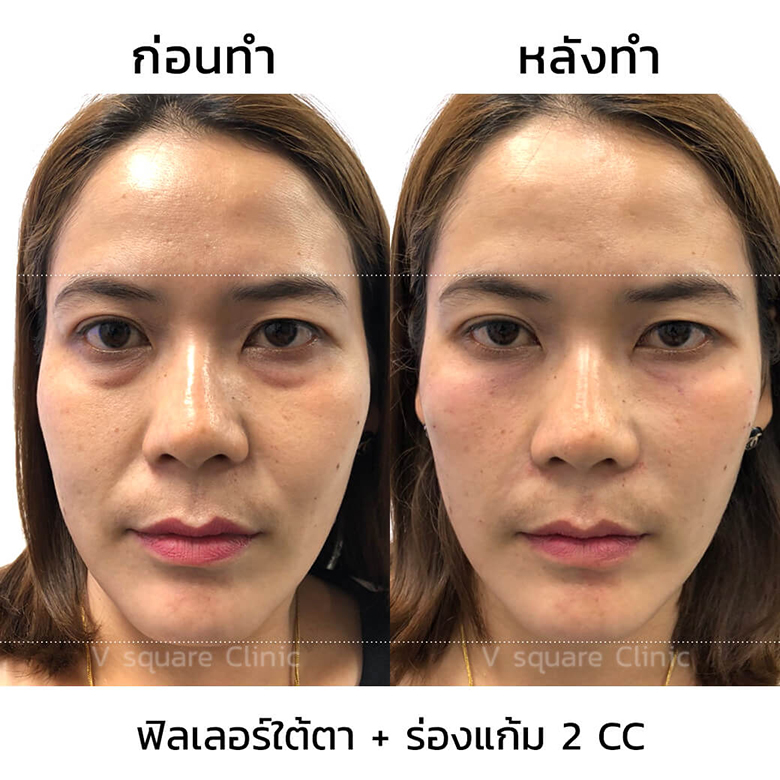 ฉีดฟิลเลอร์ใต้ตา-ร่องแก้ม-2-cc