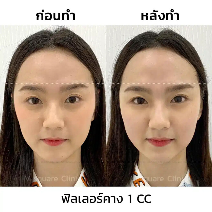 รีวิฉีดฟิลเลอร์คางแก้ไขคางสั้น