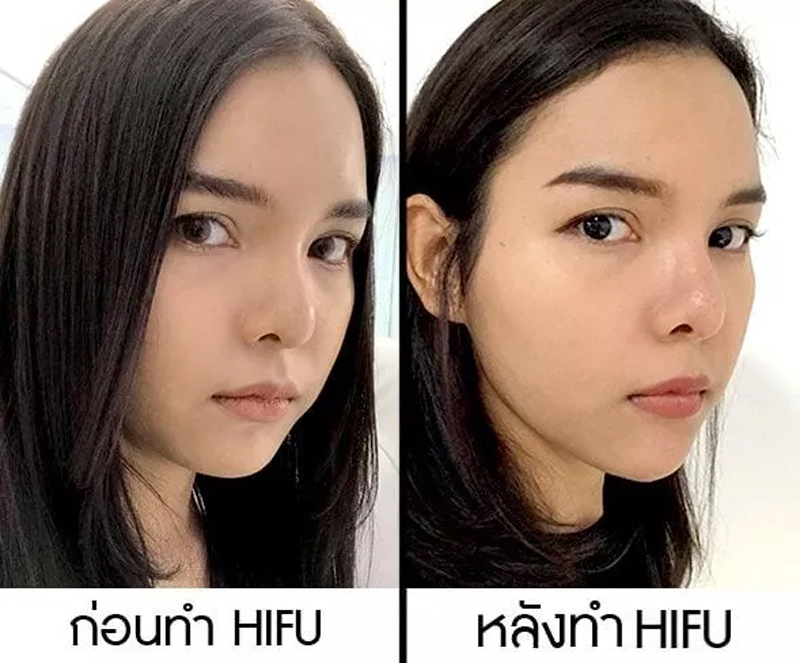 รีวิวทำhifu