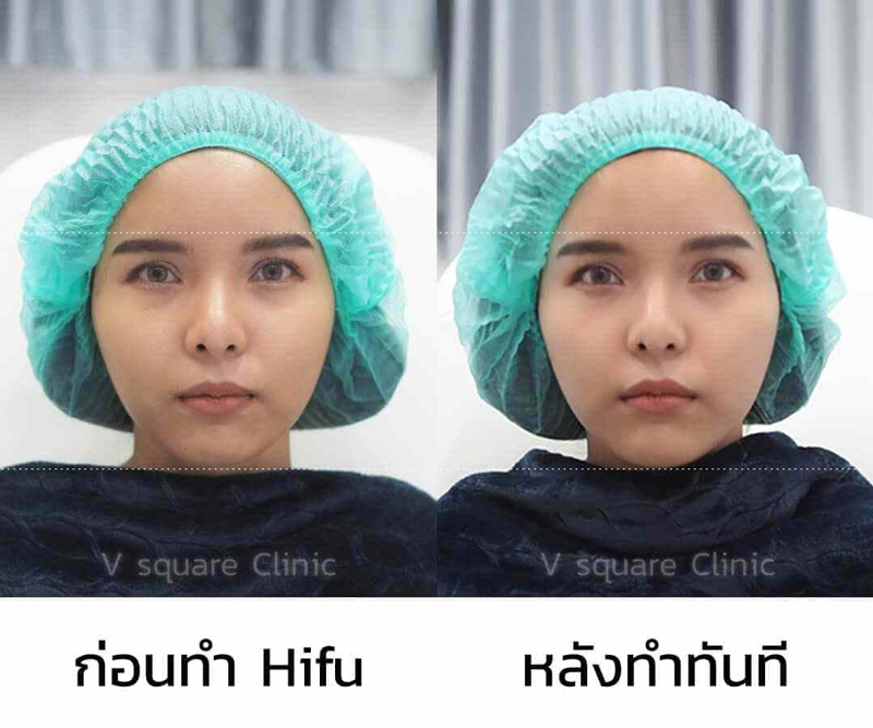 รีวิวทำhifu