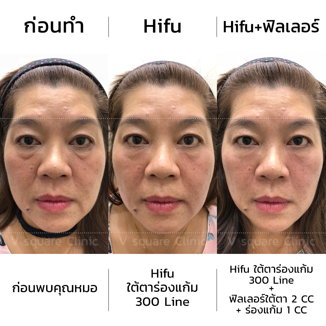 รีวิวทำhifuและฟิลเลอร์ใต้ตา