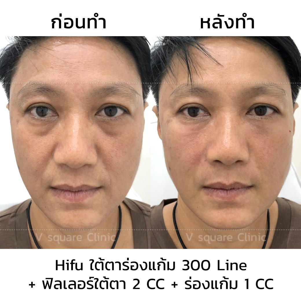 รีวิวทำhifuและฟิลเลอร์ใต้ตา