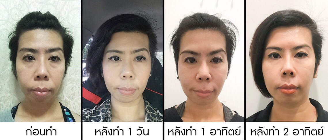 รีวิวหลังทำ2สัปดาห์