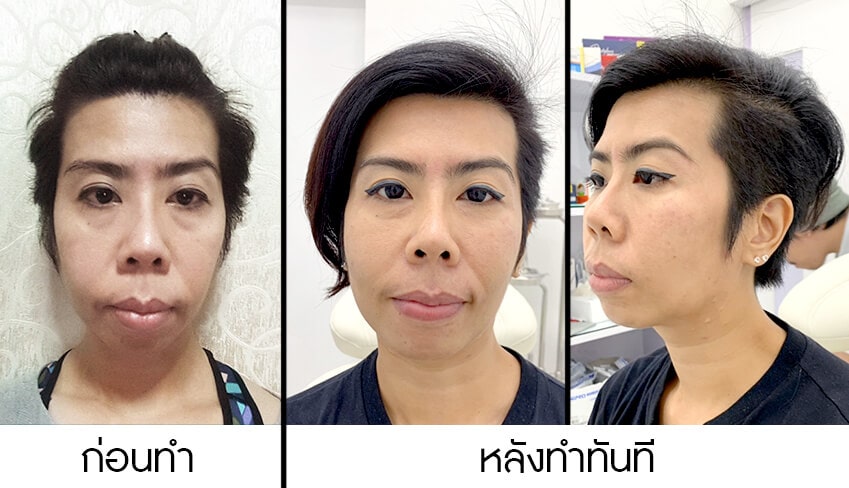 รีวิวหลังทำทันที