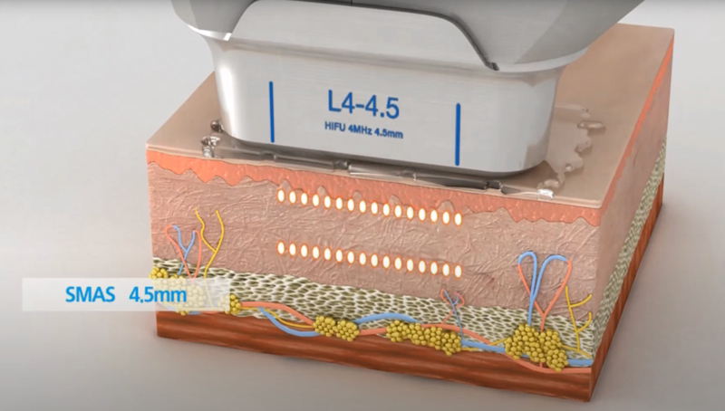 หัวยิงความลึก-4.5-mm