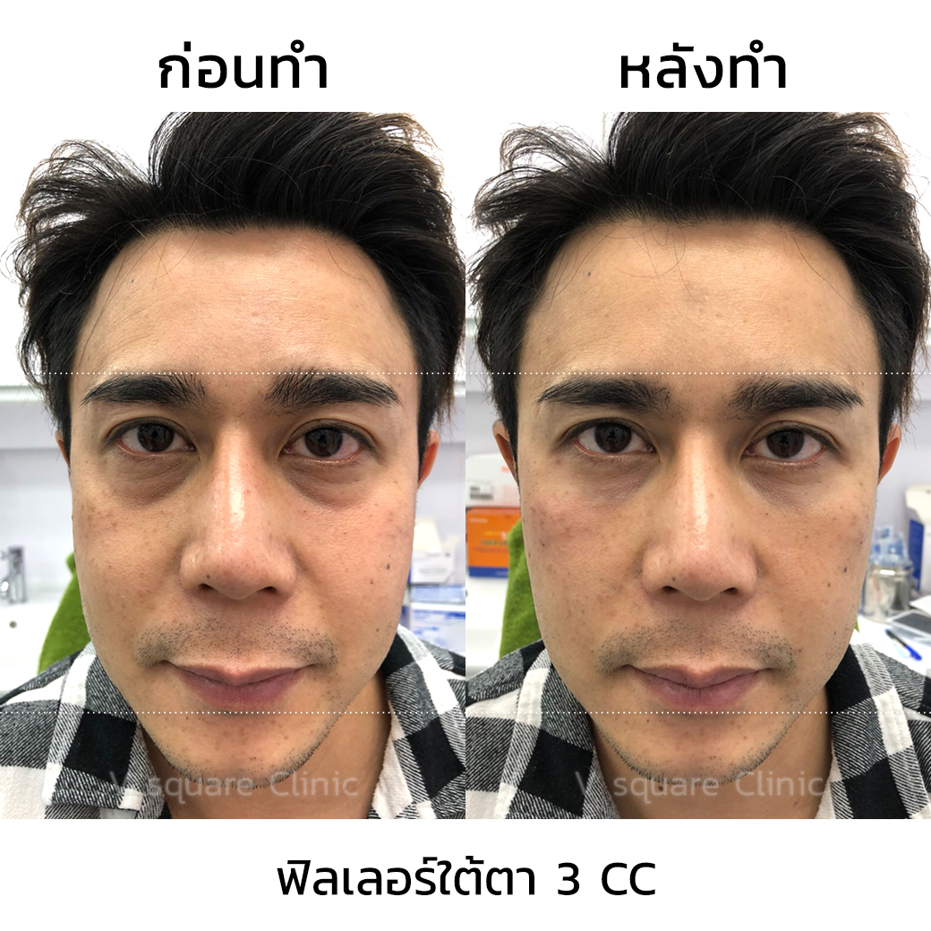 รีวิวฉีดฟิลเลอร์ใต้ตา
