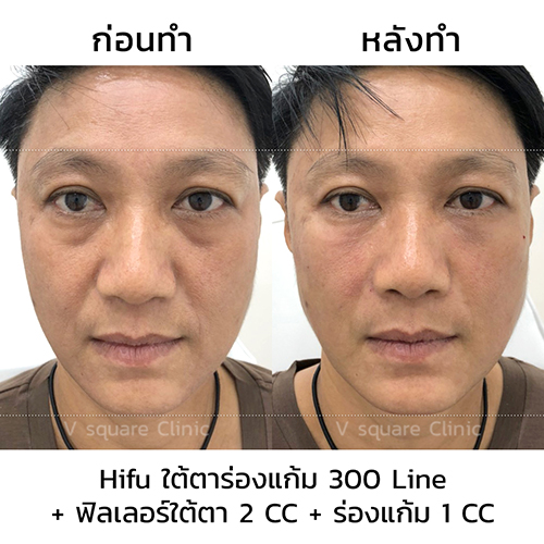 รีวิว Hifu ใต้ตา