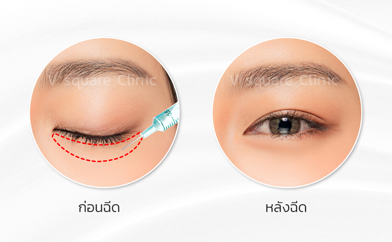 การฉีดดอลลี่อาย-บริเวณขอบตา