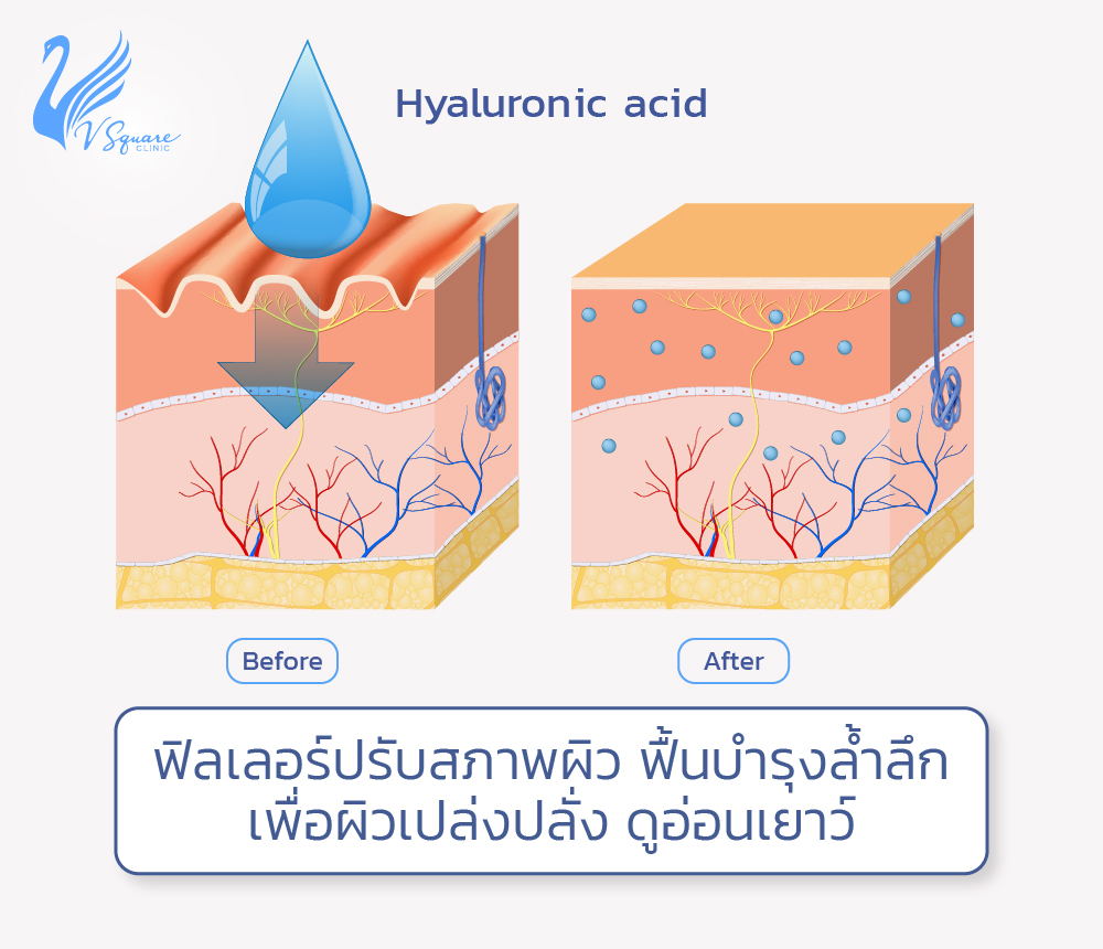 ฟิลเลอร์ปรับสภาพผิว