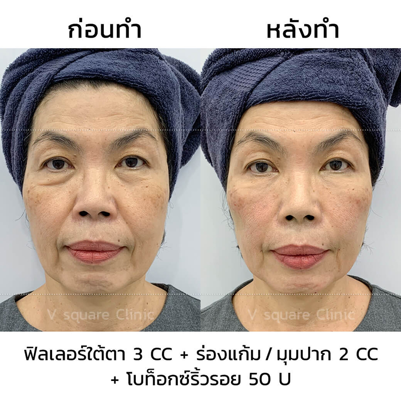 รีวิว-ฟิลเลอร์ร่องน้ำหมาก