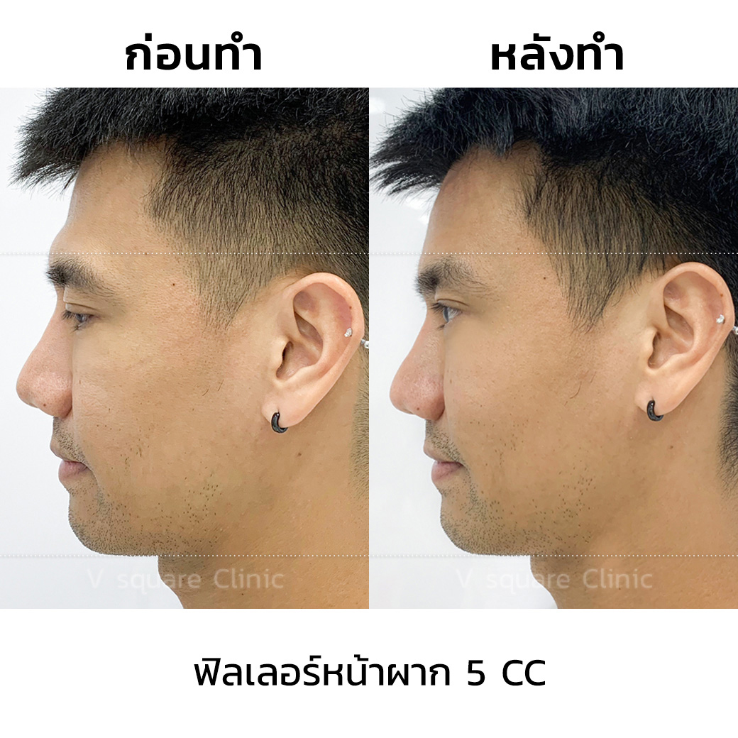 รีวิวปรับโหวงเฮ้งหน้าผาก