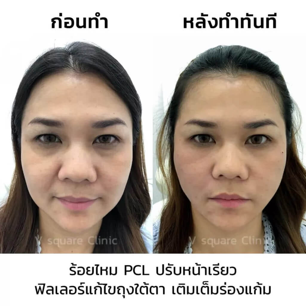 รีวิวหลังร้อยไหมPLC