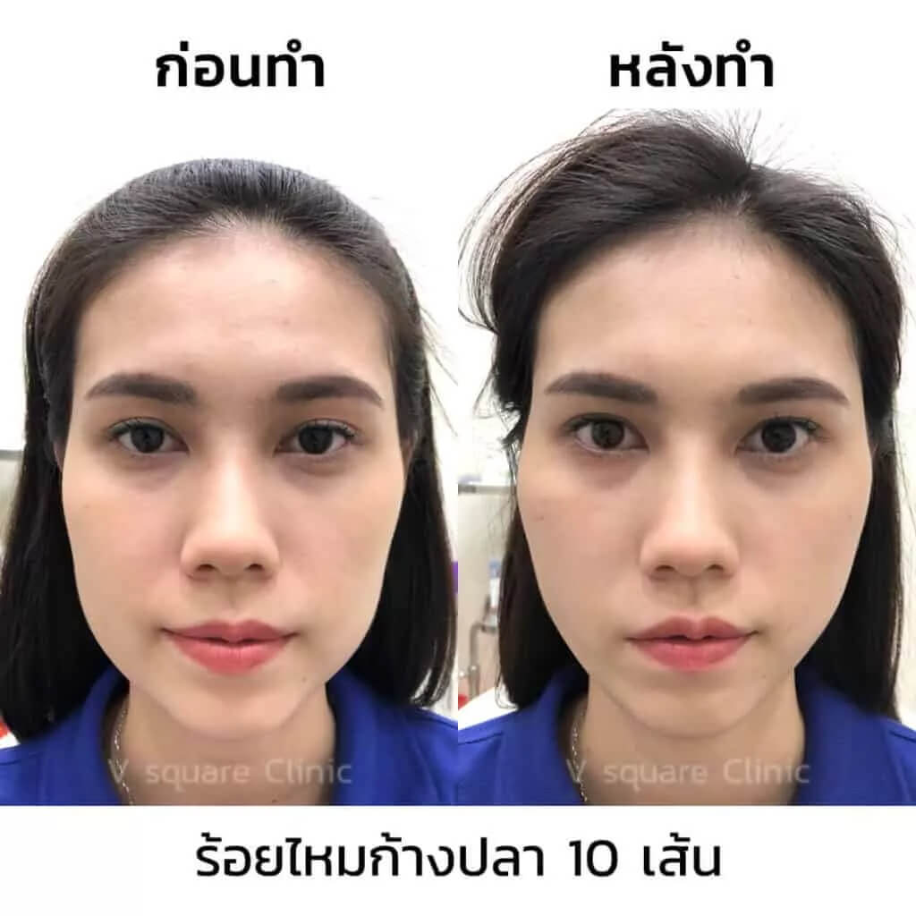 รีวิวหลังร้อยไหมก้างปลา10 เส้น