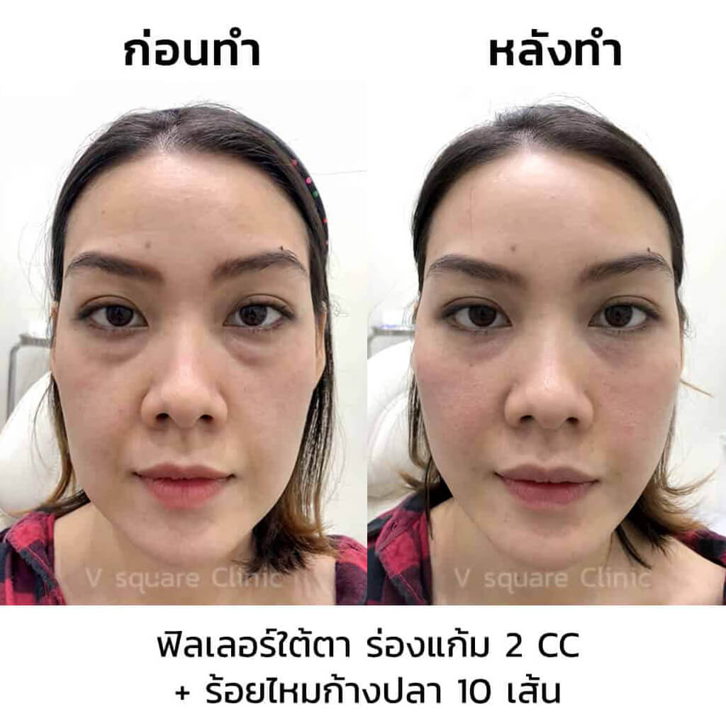 รีวิวหลังร้อยไหมก้างปลา+ฟิลเลอร์ใต้ตา