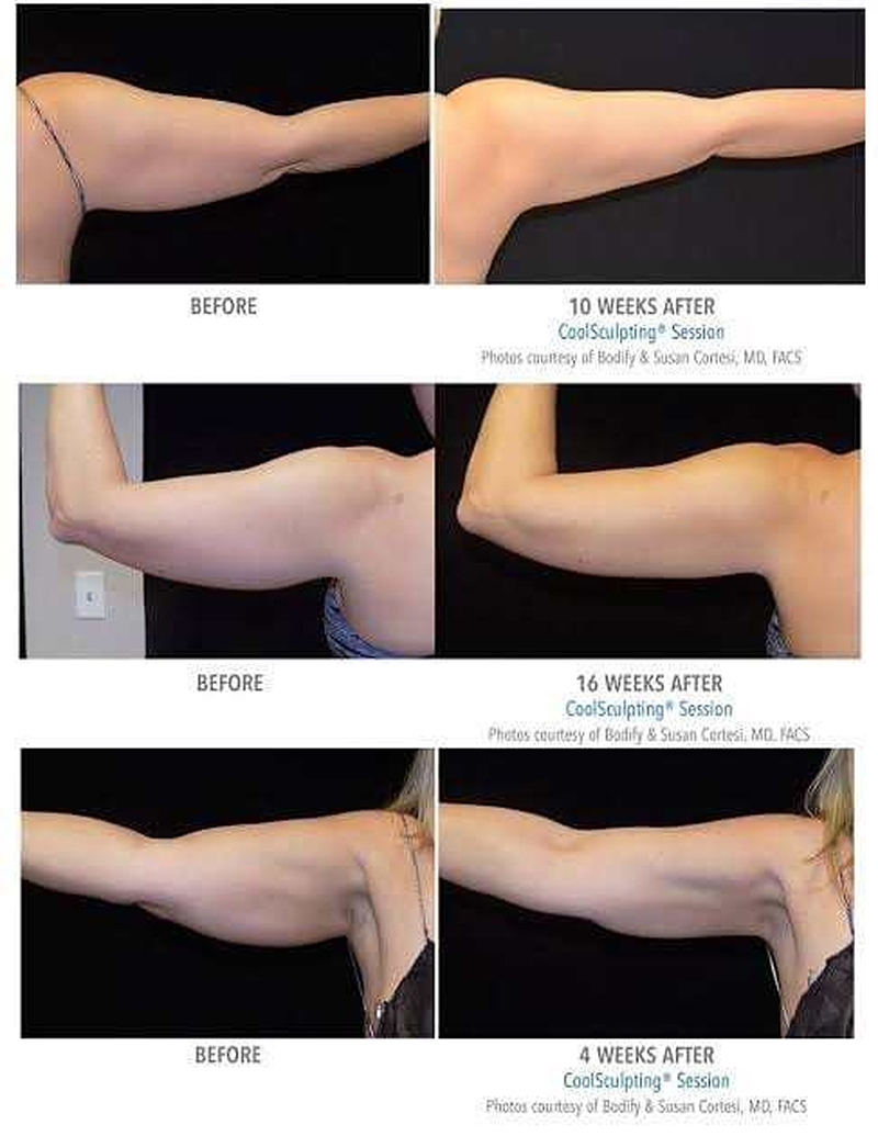 รีวิว-Coolsculpting-ต้นแขน