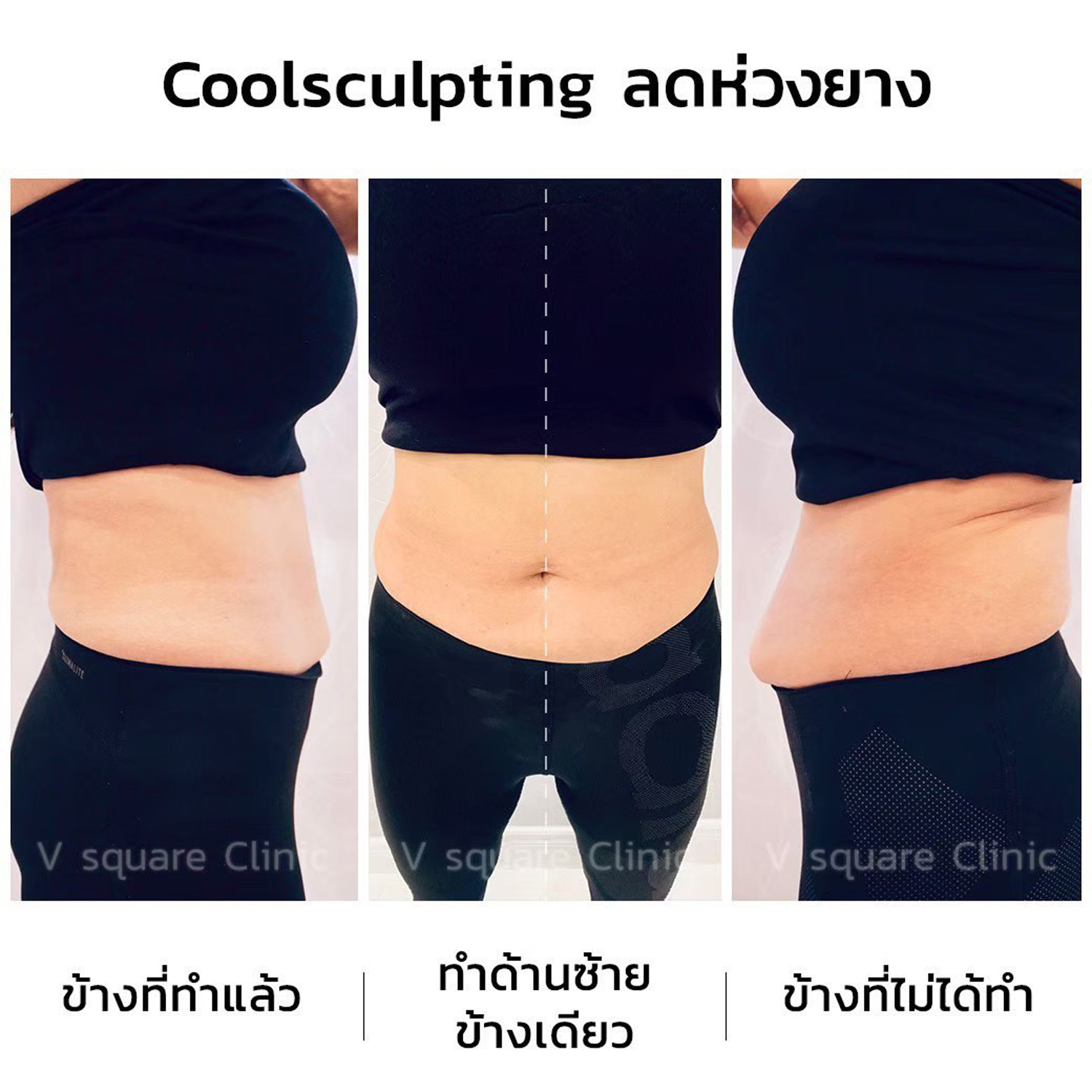 รีวิว coolsculpting