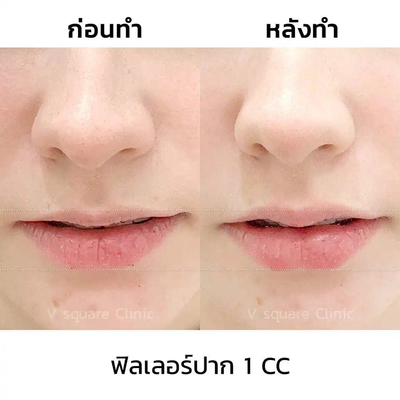 รีวิว ฟิลเลอร์ปากกระจับ