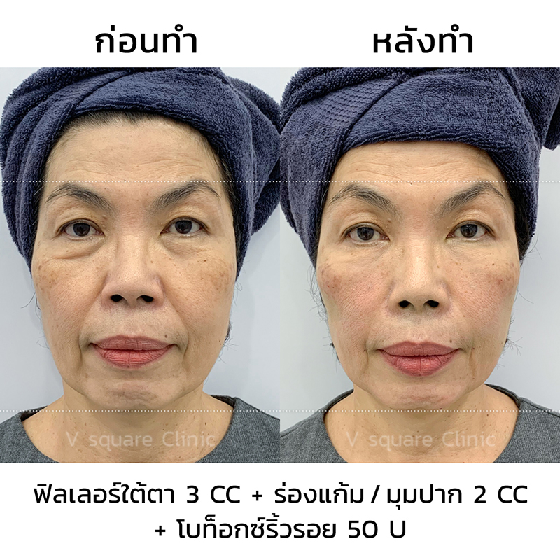 รีวิวฟิลเลอร์ยกหน้า2