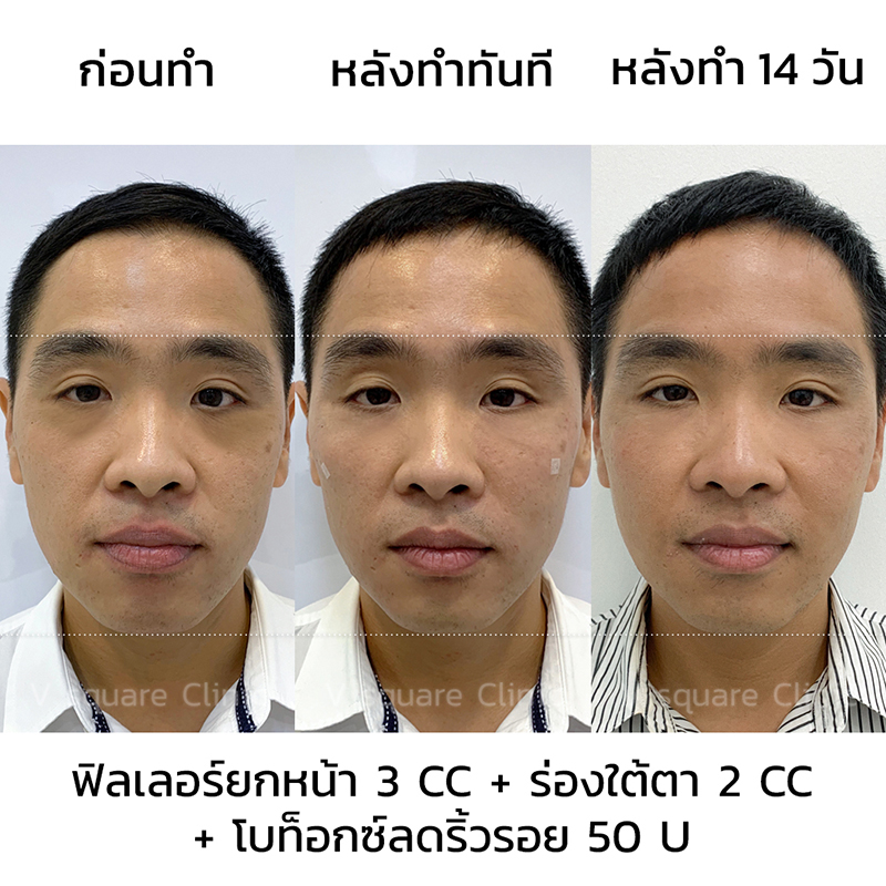 รีวิวฟิลเลอร์ยกหน้า3