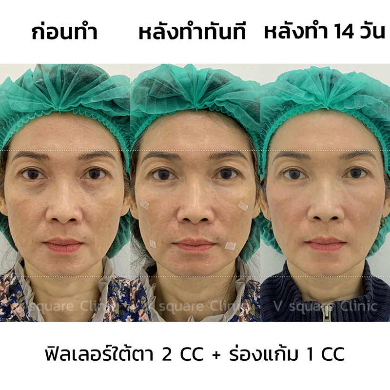 รีวิวฟิลเลอร์ยกหน้า4